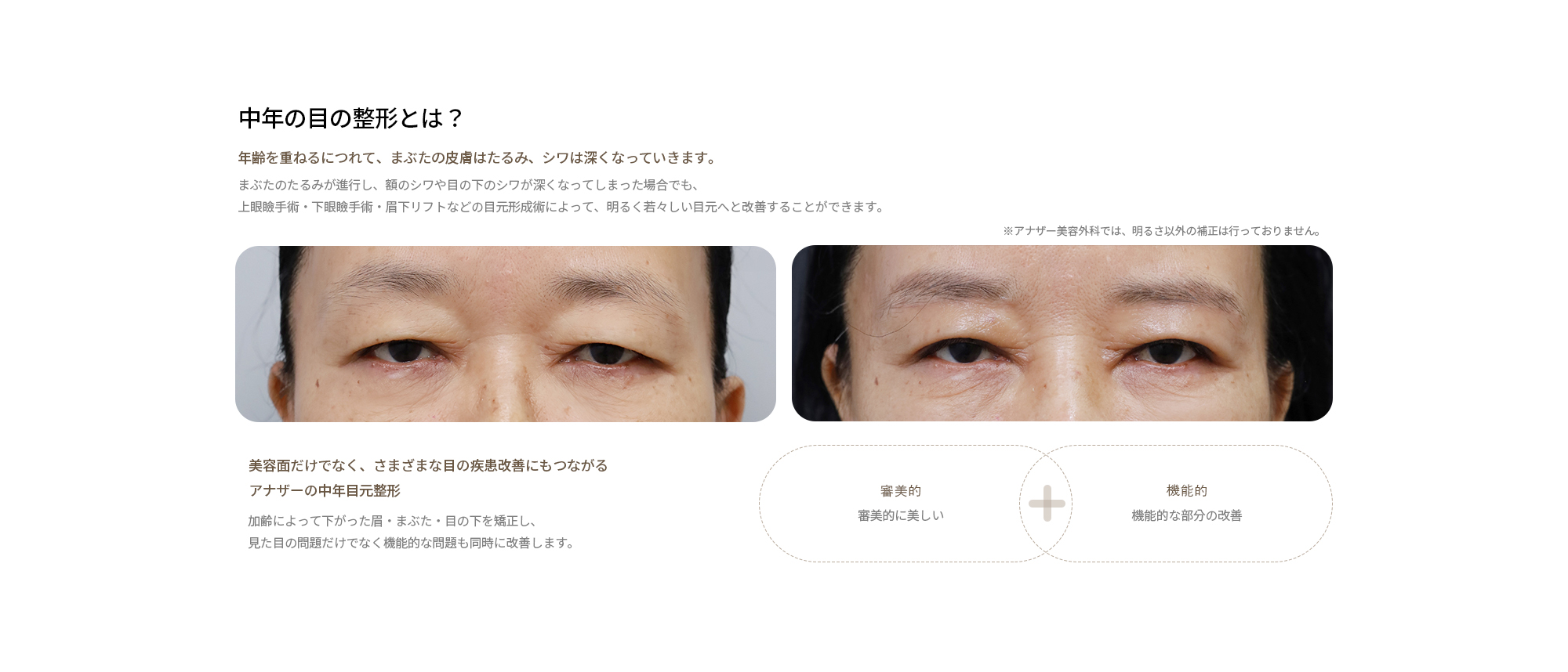 中年の目の整形